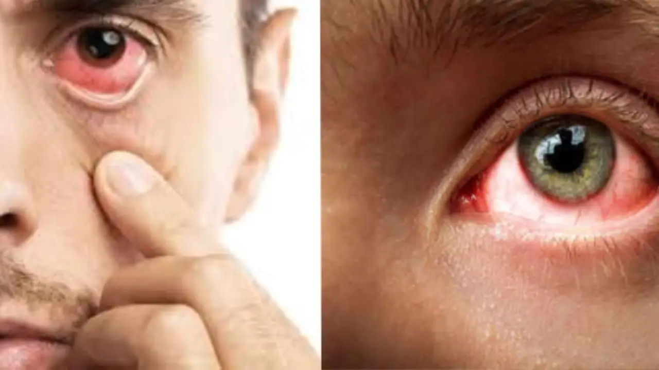 Stop fast growing eye flu like this, know symptoms and remedies