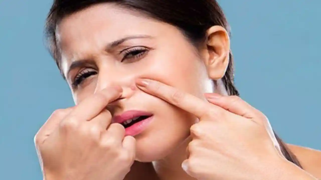 If you are also troubled by acne, then try these 5 home remedies