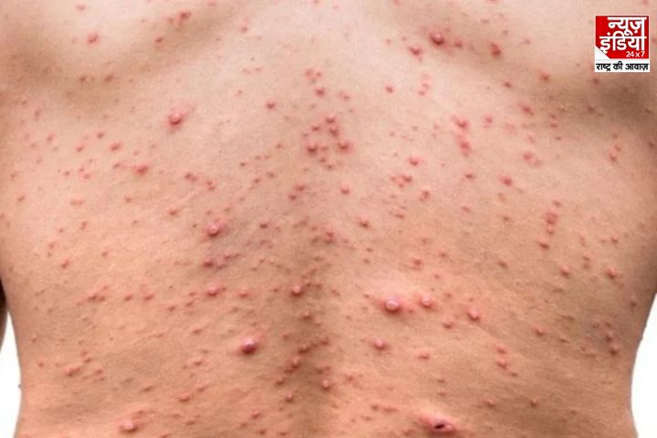 Mpox In India: केरल में मंकीपॉक्स का एक और मामला; राज्य और केंद्र सरकार सतर्क